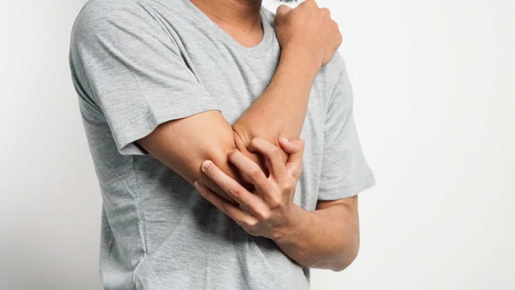 CBD et eczema bienfaits